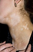 Vitiligo of the neck