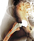 Failed hip resurfacing,X-ray