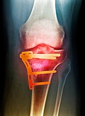 Pinned broken knee,X-ray
