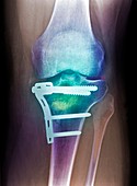 Pinned broken knee,X-ray