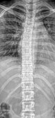 Normal spine and rib cage,X-ray