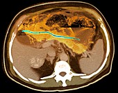 Ectopic pancreatic stent,CT scan