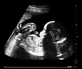 Foetus at 20 weeks,ultrasound