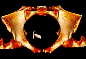 Ectopic IUD contraceptive,3D MRI scan