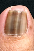 Discoloured nail