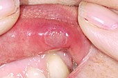 Lip ulcer after injury