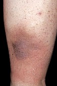 Pigmentation in the lower leg