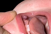 Mouth polyp