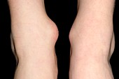 Bursitis of the ankle