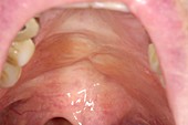 Cleft palate scar