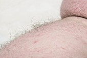 Obese man's skin