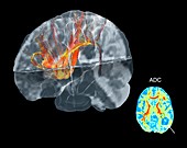 Brain cancer affecting nerve fibres