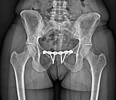 'Pinned pelvic fracture,X-ray'