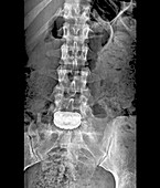 'Artificial spinal disc,X-ray'