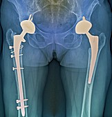 'Double hip replacement,X-ray'