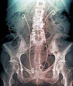 'Artificial kidney ureters,X-ray '