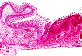 Twisted bowel,light micrograph