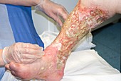 Leg ulcers on non-compliant patient
