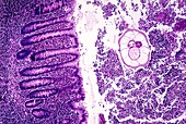 Acute appendicitis,light micrograph