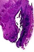 Oesophageal ulcer,light micrograph