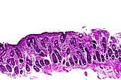 Coeliac disease,light micrograph
