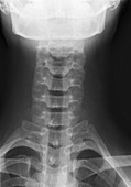 'Healthy spine of the neck,X-ray'