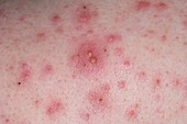 Close-up of acne vulgaris