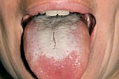 Candida infection of the tongue
