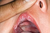 Candida infection of the mouth