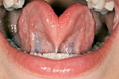 Tongue-tie (image 1 of 2)