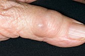 Synovial cyst on the finger