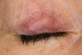Meibomian cysts in upper eyelid