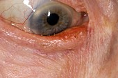 Ectropion (drooping) of the eyelid