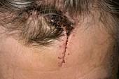 Laceration of the forehead