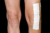Knee scars after joint replacement