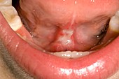 Treated tongue-tie (image 2 of 2)