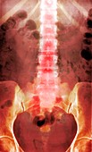 Healthy lower spine,X-ray