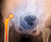 'Dislocated hip prosthesis,X-ray'