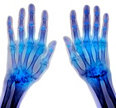 'Rheumatoid arthritis of the hands,X-ray