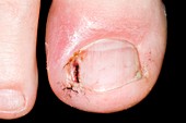 Infected ingrowing toenail