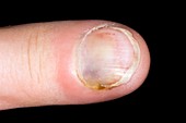 Infected bruise under the fingernail