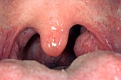 Asymmetric healthy tonsils