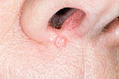 Basal cell carcinoma below the nostril