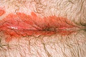 Psoriasis around the anus (image 1 of 2)