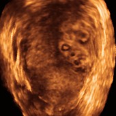 Chorion cancer,3-D ultrasound scan