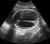 Abnormal foetus head,ultrasound