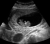 Foetus at 9 weeks,ultrasound
