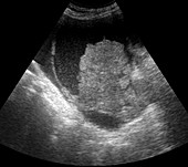 Foetal ascites,ultrasound scan