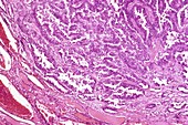Thyroid cancer,light micrograph