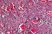 Spleen in myelofibrosis,light micrograph